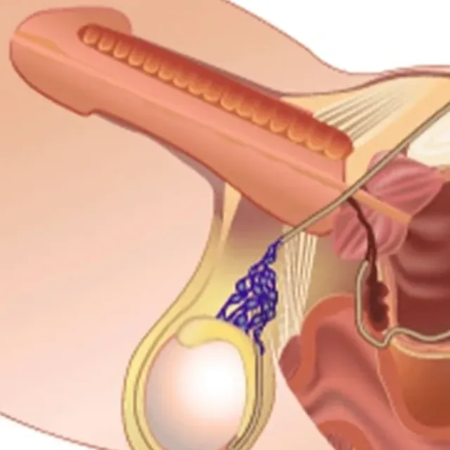 Premature Ejaculation Treatment